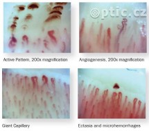 Digitální video kapilaroskop Optilia